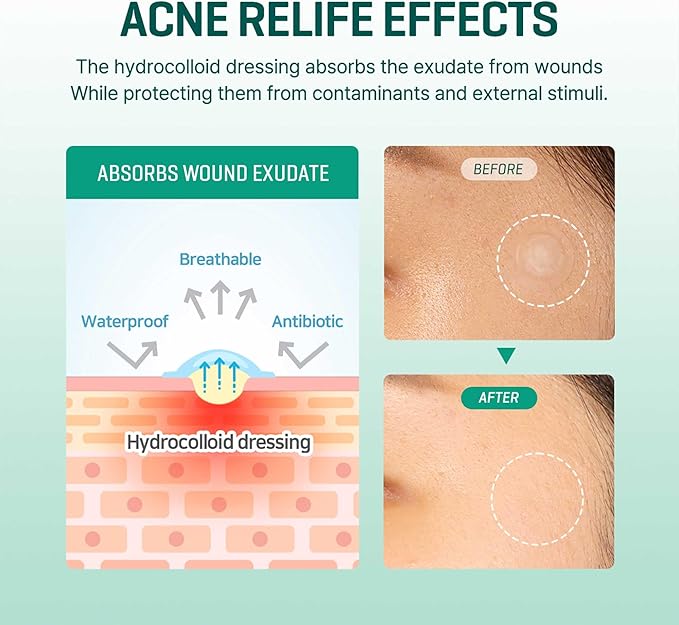 Clear hydrocolloid acne patches
